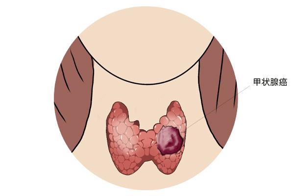 甲狀腺癌癥的主要癥狀表現(xiàn)有什么？為什么會(huì)得甲狀腺癌癥呢？
