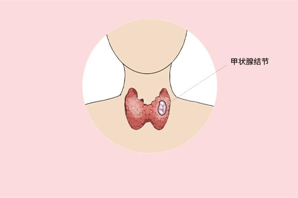 甲狀腺癌癥的主要癥狀表現(xiàn)有什么？為什么會(huì)得甲狀腺癌癥呢？